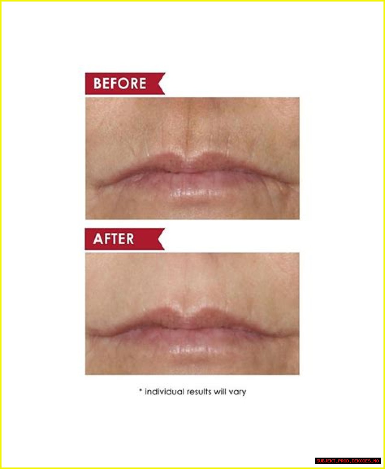 Dermelect Smooth Upper Lip Treatment Review